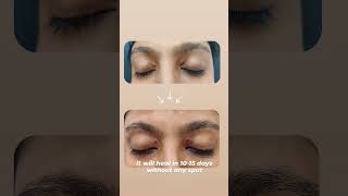 Xanthelasma palpebrarum Removal  Dr Sanchika Gupta 👩‍⚕️ [upl. by Moshell516]