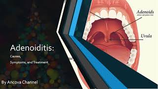 Adenoiditis PowerPoint presentation [upl. by Trebloc]