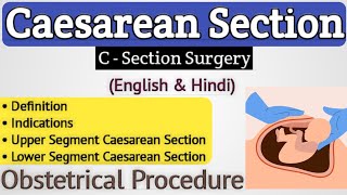 Cesarean section in hindi  Lower segment caesarean section in hindi [upl. by Nitsuj]