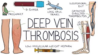 Understanding Deep Vein Thrombosis DVT [upl. by Jerrine765]