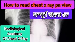 How To Read Chest XRay PA viewChest x ray radiological anatomy [upl. by Oiromed]