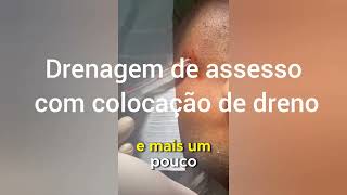 Drenagem de abscesso extra oral sem dor sob hipnoseDraining of abscess without pain under hypnosis [upl. by Odarbil852]