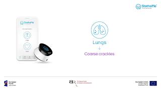 Lungs auscultation  coarse crackles 1 [upl. by Adnorehs]