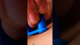 Useful skin tag remover shorts video [upl. by Savil]