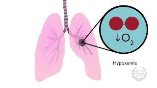 How Anesthesiologists Can Help With Transfusion related Acute Lung Injury [upl. by Jenifer222]