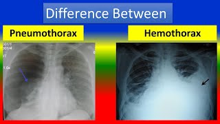 Difference between Pneumothorax and Hemothorax [upl. by Ehrenberg875]