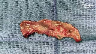 SP Robotic Diverticulectomy  Bladder Mucosa Urethroplasty [upl. by Dodi]