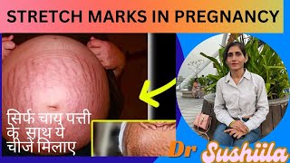 Remove Stretch Marks at Home  Pregnancy Ke Stretch Marks Hataye Naturally  stretchmarks [upl. by Ahsinut]