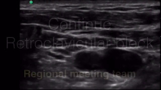 Continue Retroclavicular Brachial Plexus block [upl. by Ahsiam]