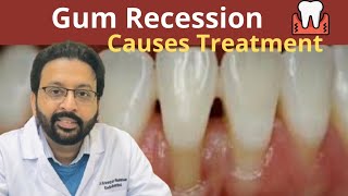 What Causes Gum Recession  How To Treat Receding Gums [upl. by Siegler]