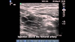 Adductor Canal Block In Plane Approach [upl. by Jarib]