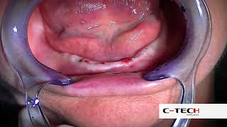 SD Mini dental implant  Flapless Technique Dottor Aldo De Blasi [upl. by Bertha904]