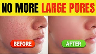 HOW TO GET RID OF LARGE PORES IN TELUGUGoodhealthbestie [upl. by Nnylasor]