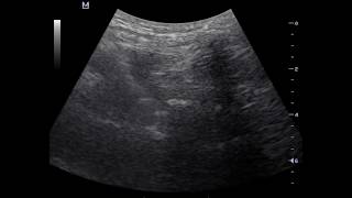 Ultrasound guided fluoroscopic verified lumbar transforaminal epidural injection [upl. by Azmah]