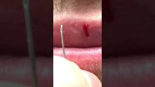 Fordyce spot on lip removal with needle 💉 [upl. by Enelyk610]