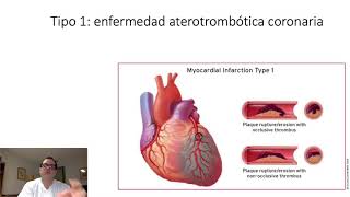 Cuarta definición Universal de Infarto del Miocardio [upl. by Eri47]