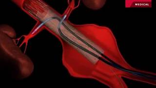 Fenestrated Endovascular Graft to Repair Abdominal Aortic Aneurysm [upl. by Lissi]