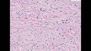 Histopathology SkinGranular cell tumor [upl. by Niklaus406]