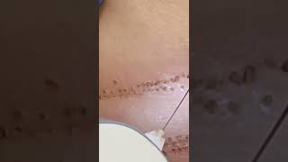 Lifting de arrugas con Plasma Pen Fibroblast [upl. by Murry]