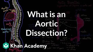 What is an aortic dissection  Circulatory System and Disease  NCLEXRN  Khan Academy [upl. by Lejeune778]