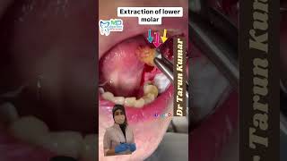 Lower MOLAR tooth extraction [upl. by Lehcear688]