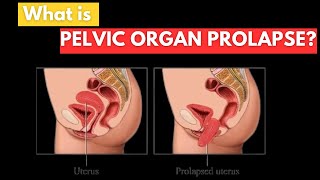 Pelvic Organ Prolapse What You Need to Know [upl. by Ellatsyrc]