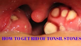 how to get rid of tonsil stones [upl. by Lehcin]