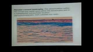 Corneal Dystrophies 2wmv [upl. by Sema534]