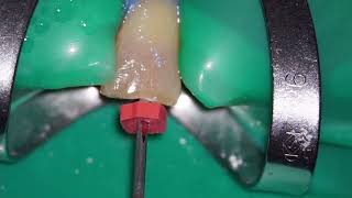 Lateral Condensation Technique of root canal filling for mandibular anterior teeth [upl. by Bloxberg]