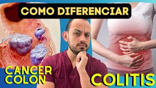 Diferencias en los Síntomas de Cáncer de Colon vs Colitis Estudios que se pueden realizar [upl. by Nazler137]