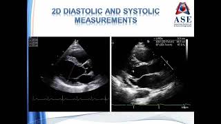 Transthoracic Echocardiogram [upl. by Ecnaiva122]