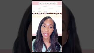 HOW TO REDUCE ACNE SCARS [upl. by Ednew]