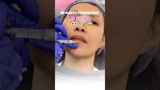 Lip Filler Treatment lipfiller fillerbibir trending trendingshorts [upl. by Aseral89]