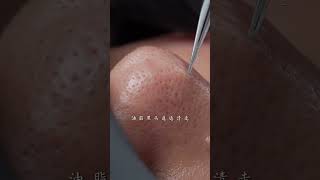 Take good care of your skin during the season change immersiveskincare blackheads asmr facespa [upl. by Finah]