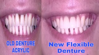 Pustiso before and after Flexible Dentures and acrylic dentures NewAcePx Composite resin teeth [upl. by Anikes594]