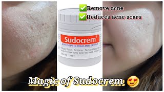 Sudocrem for acne  How to use sudocrem amp its benefits  One skincare solution [upl. by Ardnasil992]