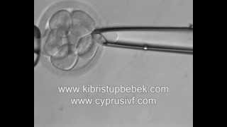 KIBRIS TÜP BEBEK BLASTOMER BİYOPSİ  BLASTOMER BIOPSY [upl. by Lat5]