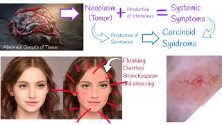 Carcinoid syndrome  Symptoms and treatment Carcinoid Heart Disease [upl. by Anees]