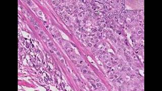 Histopathology Urinary bladderTransitional cell carcinoma [upl. by Llenad]