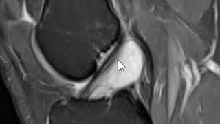 ACL Cyst [upl. by Mcnelly]