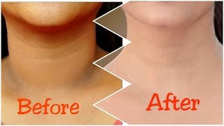 How To Get Rid of Dark Neck in 15 Minutes  Fast and Quickly [upl. by Lucila]