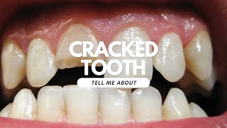 Cracked Tooth [upl. by Gabel]