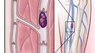 Deep Vein Thrombosis [upl. by Ttcos]