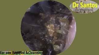 Swollen Expanded Ear Wax Removal 245 [upl. by Mcclimans]