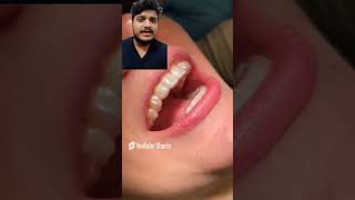 Fixed retainers after orthodontic treatment trending hospital dentalschoollife viralvideo [upl. by Patrizio]