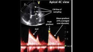 Mitral stenosis Quantification Gradients CE PISA and MV Resistance [upl. by Anelrac]