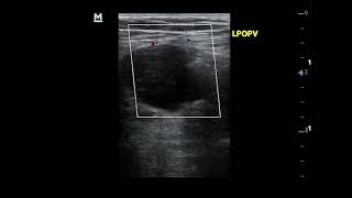 Popliteal vein aneurysm Duplex ultrasound views [upl. by Chitkara234]