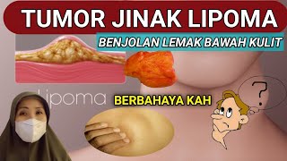 BENJOLAN LUNAK PADA TUBUH LIPOMA  APAKAH LIPOMA TERMASUK KANKER [upl. by Hike107]