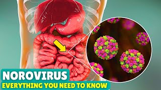 Norovirus Explained Causes Symptoms and How to Recover Fast [upl. by Thanh]