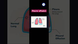 Pleural effusion Xray chest PAtypes of fluidetiology [upl. by Aikram]